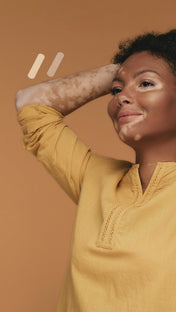 A brown skin woman with vitiligo and skin tone Browndages bandages to match her skin. Sold at My Nude Shade.